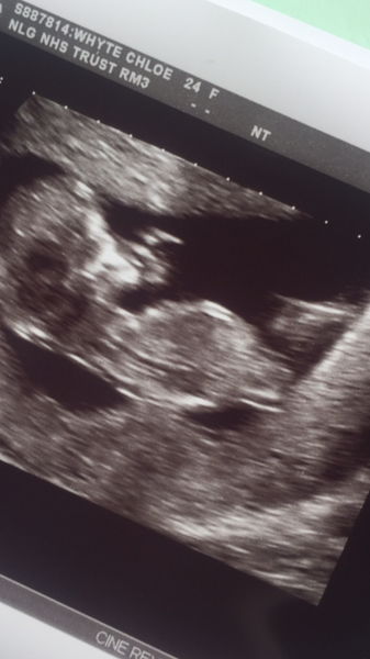Gender guess from 12 week scan - nub theory