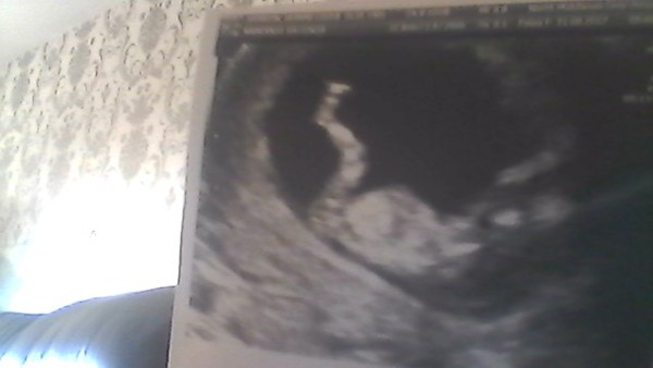 11 weeks 3 days pregnant  due 14/03/2018 and need advice please