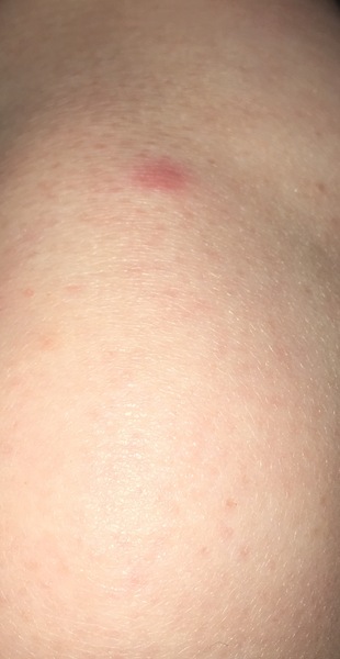 Being bit to an inch of my life ..please help before I go insane.