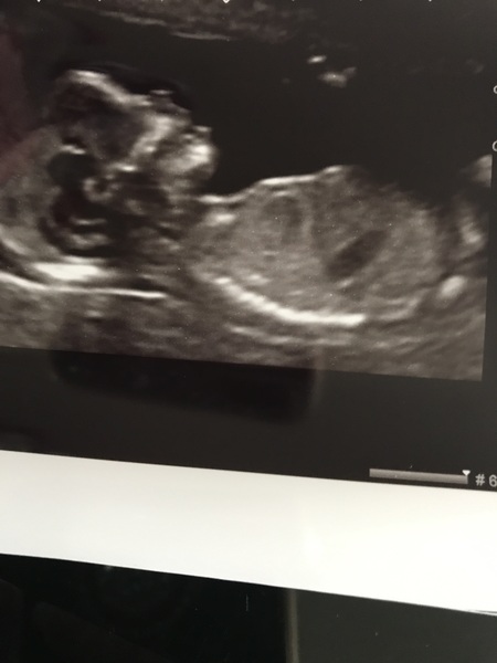 Any sonographer or nub experts please