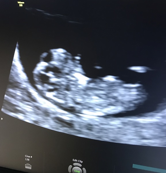 Thread no.2 for babies due April 2018