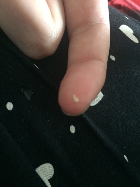 I think I have a tonsil stone??? *pics*