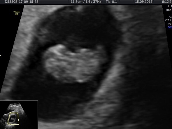 Thread no.2 for babies due April 2018