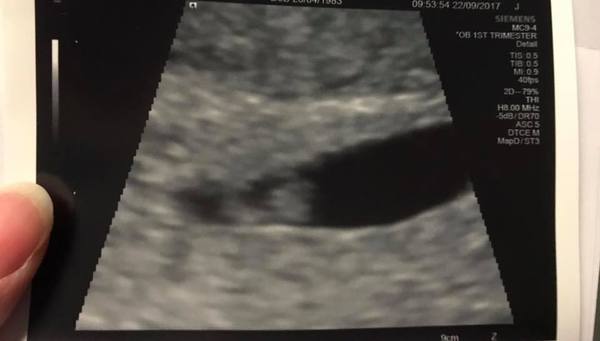 May 2018 thread 2: first trimester, early scans and first heartbeats