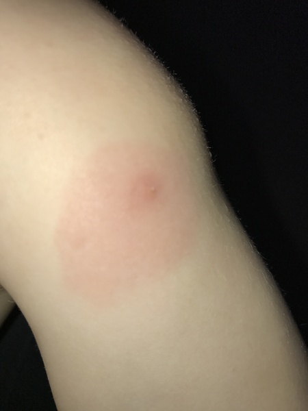 Does this look like a bite?