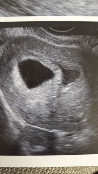 Just found out I have a subchorionic haematoma. Can anyone shed any light?