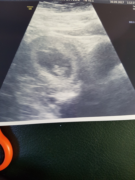 Had my early private scan