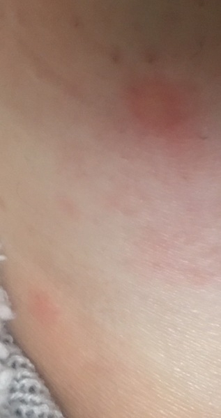 Being bit to an inch of my life ..please help before I go insane.