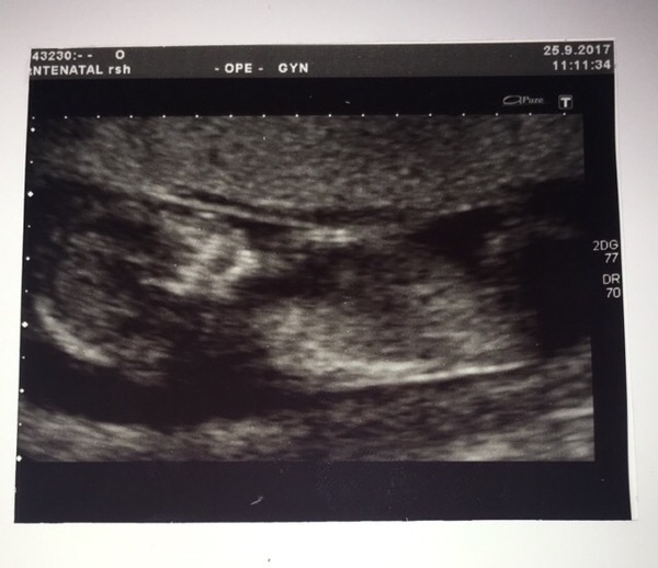 Boy or girl?