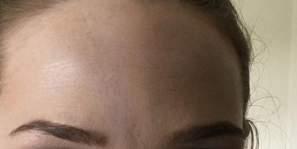 Does anyone know what this purple discolouration on my forehead could be? Pics attached. Massive health anxiety suffered so worried sick :(