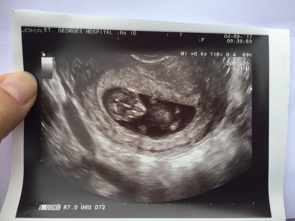 Pregnancies due March 2018