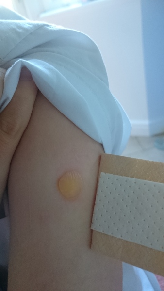 Weird painful boil-like spot appeared on ds overnight???