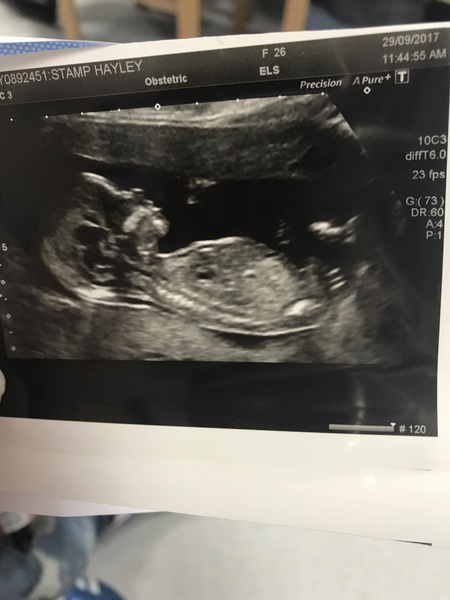 12 week scan gender guesses