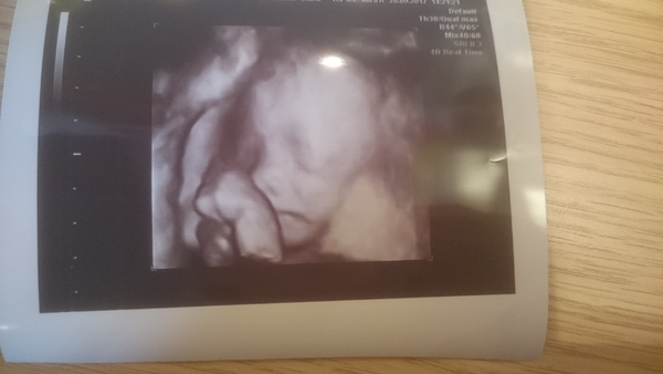 Hyperemesis Support