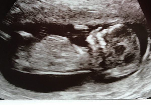 Thread no.2 for babies due April 2018