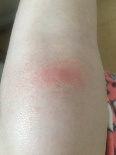 Being bit to an inch of my life ..please help before I go insane.