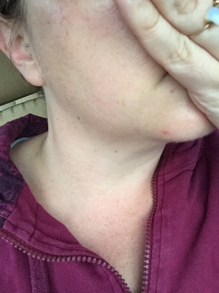 SKIncare advice please - acids? With pic