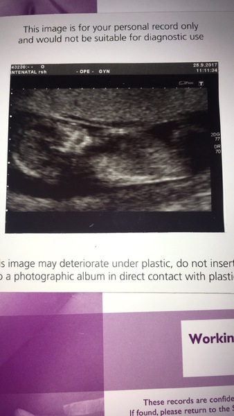 12 week scan?? Any ideas