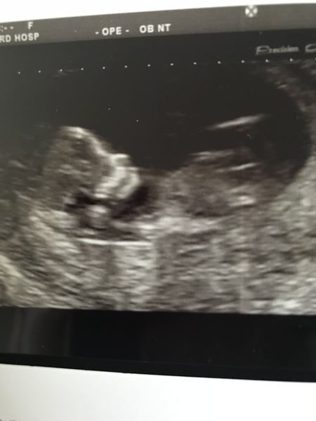 12 week scan gender guesses