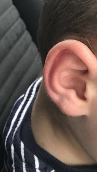 Does my son's ear look normal to you?