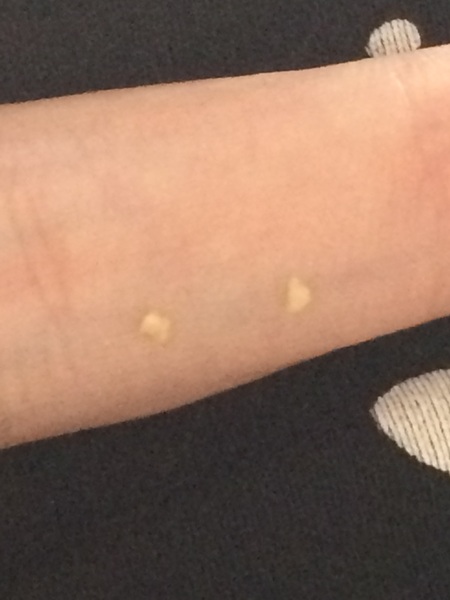 I think I have a tonsil stone??? *pics*