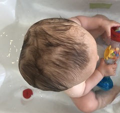 Positional plagiocephaly