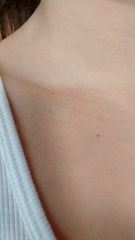 Does anyone know what this rash is?