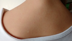 Does anyone know what this rash is?