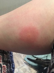 What the heck has bit me?!