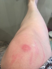What the heck has bit me?!