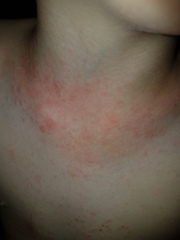 rash