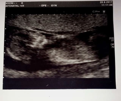 12 week scan?? Any ideas