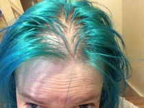 Biotin and/or supplements for hair/nails