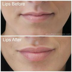 So I have booked in to have lip filler :terrified: