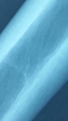 Photos!  How is this not a fracture? Any orthopods/ortho nurses around?