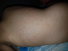 rash