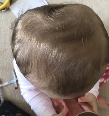 Positional plagiocephaly