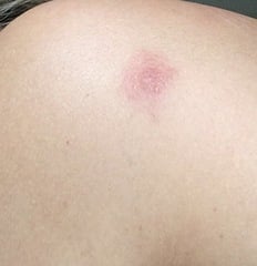 That I've not been given antibiotics for a tick bite despite the bite area getting worse and still red one month later!