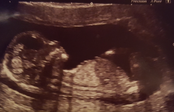 Nub theory anyone? 13 weeks