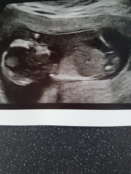 Gender predictions. 13 weeks 4 days