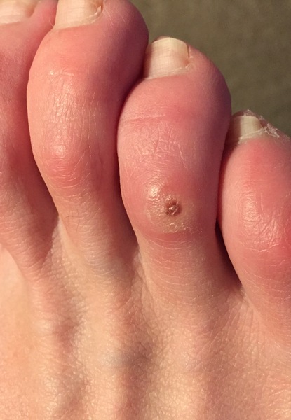 Is this normal for a corn? (contains toe pic SORRY)