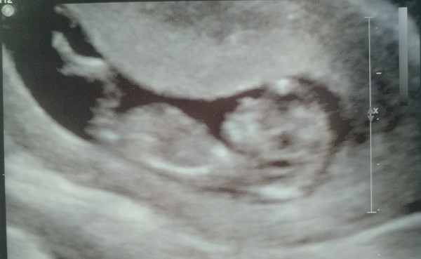 May 2018 thread 3, 12 week scans and heading towards the 2nd trimester