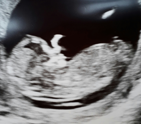 Thread no.2 for babies due April 2018