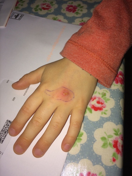 Infected hand?