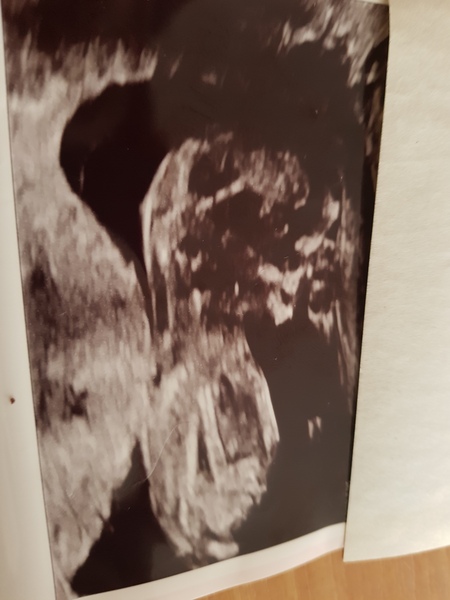 12 week scan Boy or Girl??