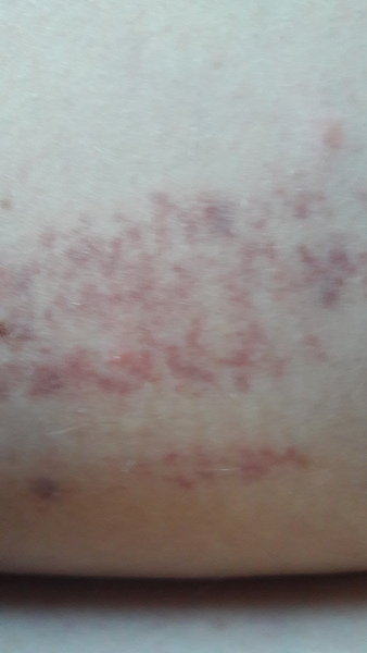 Help! Skin mystery, possible psoriasis link? Pic