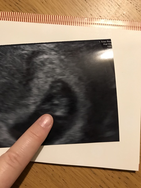 Miscarriage at 5.5 weeks vs miscarriage at 11 weeks?