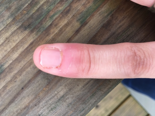nail / finger infection (pic)