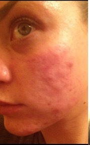 Roaccutane