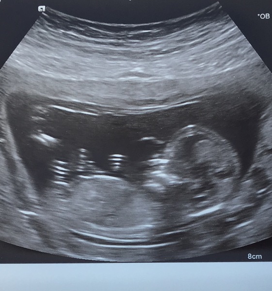 13 week 3 days scan. Gender predictions please!